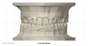 Frontal view of the based study models in occlusion