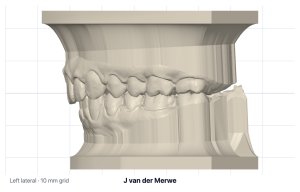 Left lateral view of the based study models in occlusion