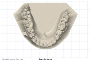 Mandibular occlusal view of the based lower model