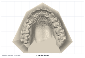 Maxillary occlusal view of the based upper model