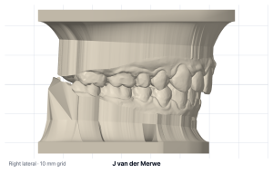 Right lateral view of the based study models in occlusion